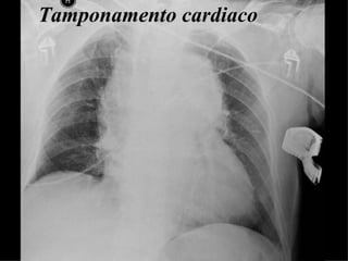 Tamponamento cardiaco 