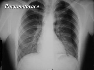 Pneumotorace 