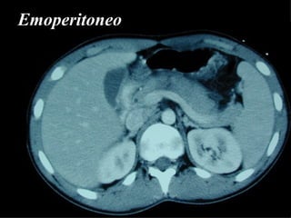 Emoperitoneo 
