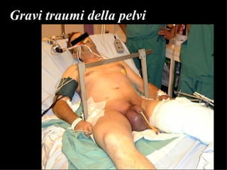 Gravi traumi della pelvi 