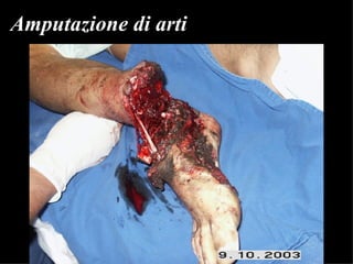 Amputazione di arti 