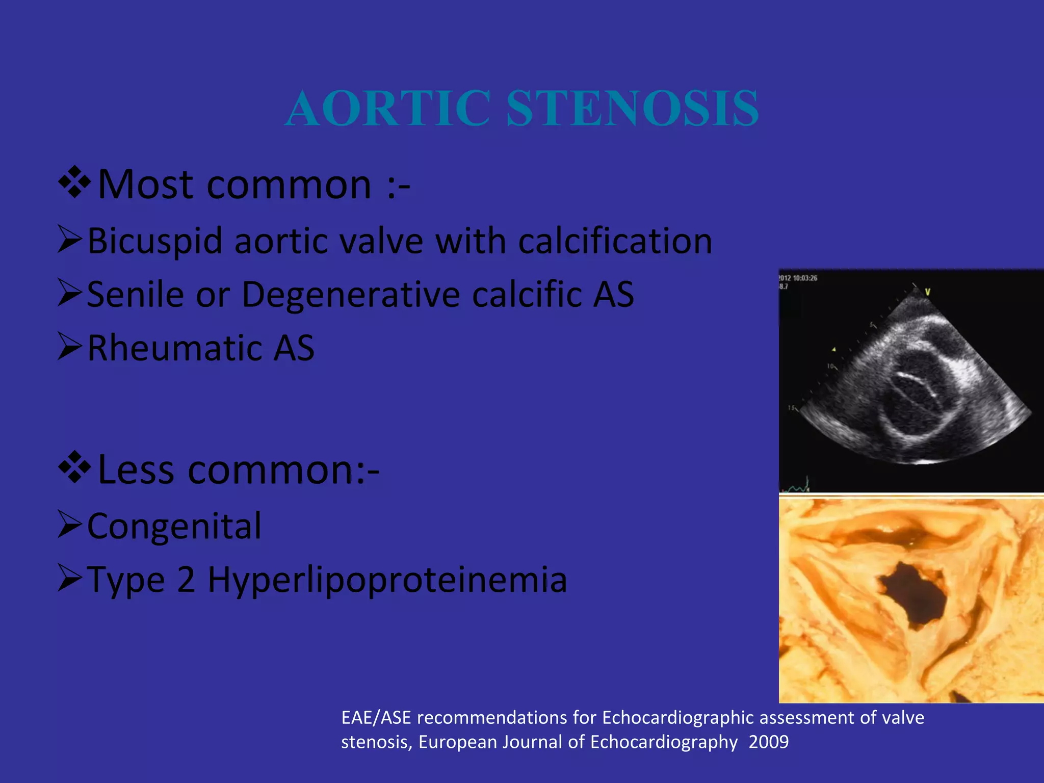 Echo assessment of Aortic valve disease, Dr Ferdous assistant registrar ...