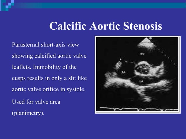 Echo assessment of Aortic valve disease, Dr Ferdous assistant registrar ...
