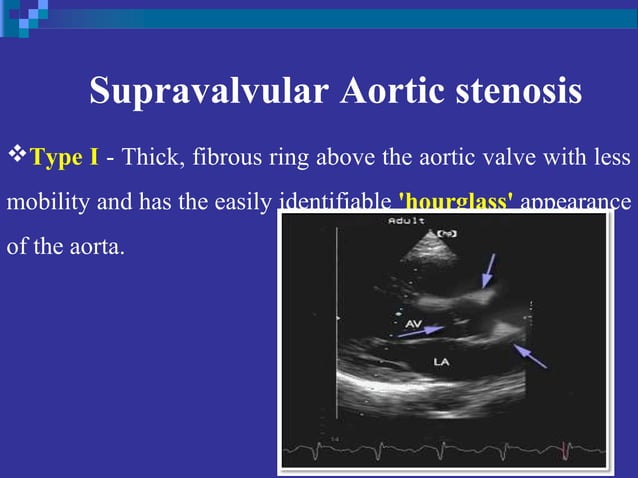 Echo assessment of Aortic valve disease, Dr Ferdous assistant registrar ...
