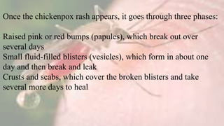 Once the chickenpox rash appears, it goes through three phases:
Raised pink or red bumps (papules), which break out over
several days
Small fluid-filled blisters (vesicles), which form in about one
day and then break and leak
Crusts and scabs, which cover the broken blisters and take
several more days to heal
 