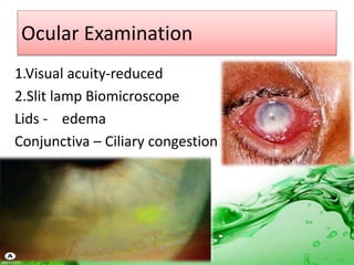 Ocular Examination
1.Visual acuity-reduced
2.Slit lamp Biomicroscope
Lids - edema
Conjunctiva – Ciliary congestion
 