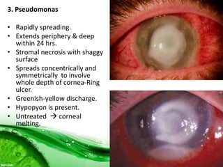 3. Pseudomonas
• Rapidly spreading.
• Extends periphery & deep
within 24 hrs.
• Stromal necrosis with shaggy
surface
• Spreads concentrically and
symmetrically to involve
whole depth of cornea-Ring
ulcer.
• Greenish-yellow discharge.
• Hypopyon is present.
• Untreated  corneal
melting.
 