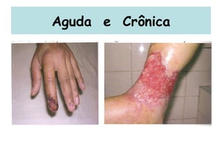 Aguda  e  Crônica 