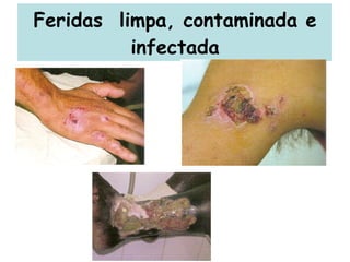 Feridas  limpa, contaminada e infectada 