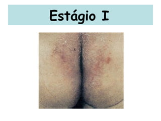 Estágio I   