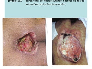 Estágio III :  perda total do  tecido cutâneo, necrose do tecido subcutâneo até a fáscia muscular; 