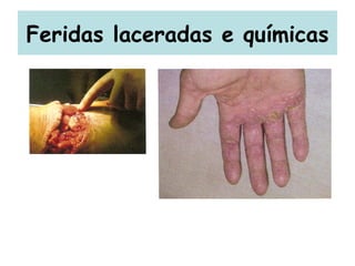 Feridas laceradas e químicas 