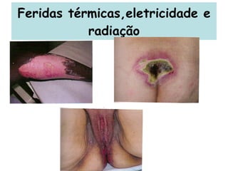 Feridas térmicas,eletricidade e radiação 