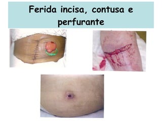 Ferida incisa, contusa e perfurante 
