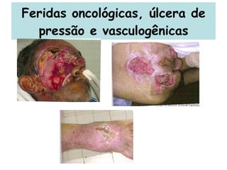 Feridas oncológicas, úlcera de pressão e vasculogênicas 