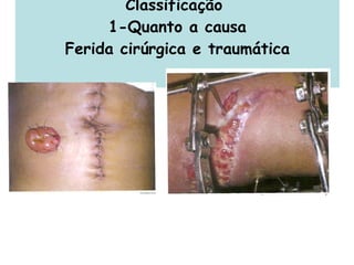 Classificação  1-Quanto a causa Ferida cirúrgica e traumática 