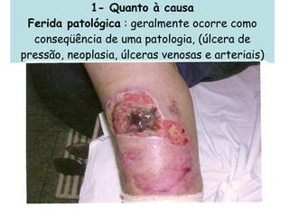 1- Quanto à causa Ferida patológica  : geralmente ocorre como conseqüência de uma patologia, (úlcera de pressão, neoplasia, úlceras venosas e arteriais) 