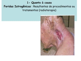 1- Quanto à causa Feridas Iatrogênicas  : Resultantes de procedimentos ou tratamentos (radioterapia) 