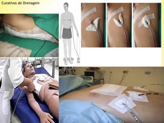 Curativos de Drenagem

Procedimentos:

Procedimentos:

 