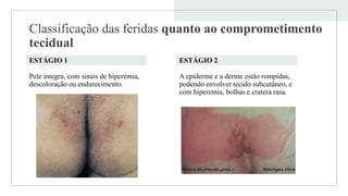 Classificação das feridas quanto ao comprometimento
tecidual
ESTÁGIO 1
Pele íntegra, com sinais de hiperemia,
descoloração ou endurecimento.
ESTÁGIO 2
A epiderme e a derme estão rompidas,
podendo envolver tecido subcutâneo, e
com hiperemia, bolhas e cratera rasa.
 