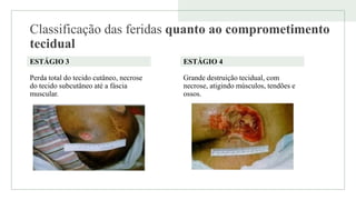 Classificação das feridas quanto ao comprometimento
tecidual
ESTÁGIO 3
Perda total do tecido cutâneo, necrose
do tecido subcutâneo até a fáscia
muscular.
ESTÁGIO 4
Grande destruição tecidual, com
necrose, atigindo músculos, tendões e
ossos.
 