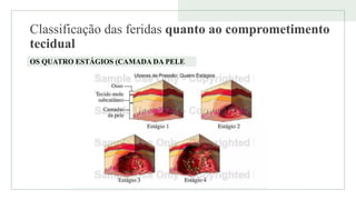 Classificação das feridas quanto ao comprometimento
tecidual
OS QUATRO ESTÁGIOS (CAMADA DA PELE
 