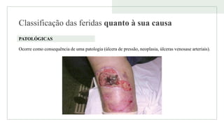 Classificação das feridas quanto à sua causa
PATOLÓGICAS
Ocorre como consequência de uma patologia (úlcera de pressão, neoplasia, úlceras venosase arteriais).
 