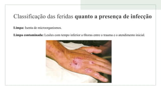 Classificação das feridas quanto a presença de infecção
Limpa: Isenta de microorganismos.
Limpa contaminada: Lesões com tempo inferior a 6horas entre o trauma e o atendimento inicial.
 