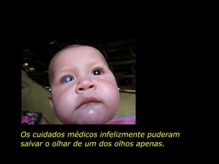 Os cuidados médicos infelizmente puderam salvar o olhar de um dos olhos apenas.  