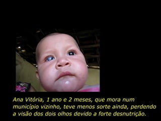 Ana Vitória, 1 ano e 2 meses, que mora num município vizinho, teve menos sorte ainda, perdendo a visão dos dois olhos devido a forte desnutrição.   