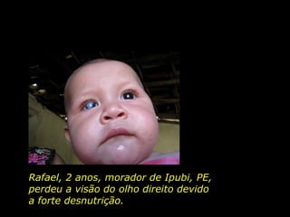 Rafael, 2 anos, morador de Ipubi, PE,  perdeu a visão do olho direito devido  a forte desnutrição.   
