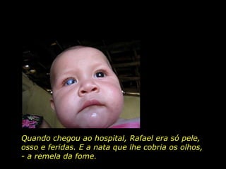 Quando chegou ao hospital, Rafael era só pele,  osso e feridas. E a nata que lhe cobria os olhos, - a remela da fome.  