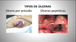 FERIDAS E CURATIVOS.pptx