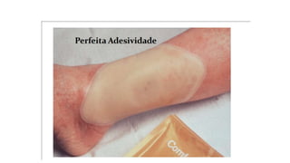 FERIDAS E CURATIVOS.pptx