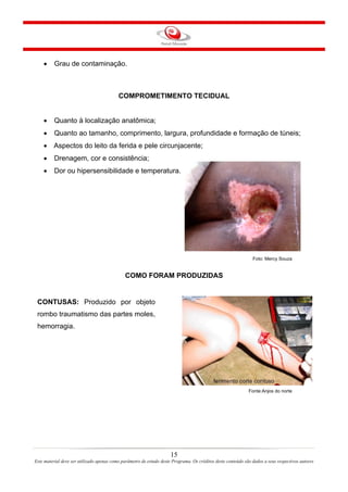 •

Grau de contaminação.

COMPROMETIMENTO TECIDUAL
•

Quanto à localização anatômica;

•

Quanto ao tamanho, comprimento, largura, profundidade e formação de túneis;

• Aspectos do leito da ferida e pele circunjacente;
•

Drenagem, cor e consistência;

•

Dor ou hipersensibilidade e temperatura.

Foto: Mercy Souza

COMO FORAM PRODUZIDAS

CONTUSAS: Produzido por objeto
rombo traumatismo das partes moles,
hemorragia.

Fonte:Anjos do norte

15
Este material deve ser utilizado apenas como parâmetro de estudo deste Programa. Os créditos deste conteúdo são dados a seus respectivos autores

 