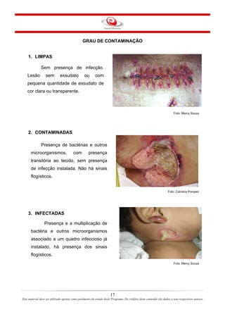 GRAU DE CONTAMINAÇÃO

1. LIMPAS
Sem presença de infecção.
Lesão

sem

exsudato

ou

com

pequena quantidade de exsudato de
cor clara ou transparente.

Foto: Mercy Souza

2. CONTAMINADAS
Presença de bactérias e outros
microorganismos,

com

presença

transitória ao tecido, sem presença
de infecção instalada. Não há sinais
flogísticos.

Foto: Carolina Pompeo

3. INFECTADAS
Presença e a multiplicação de
bactéria e outros microorganismos
associado a um quadro infeccioso já
instalado, há presença dos sinais
flogísticos.
Foto: Mercy Souza

17
Este material deve ser utilizado apenas como parâmetro de estudo deste Programa. Os créditos deste conteúdo são dados a seus respectivos autores

 