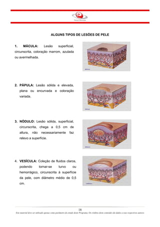 ALGUNS TIPOS DE LESÕES DE PELE

1.

MÁCULA:

Lesão

superficial,

circunscrita, coloração marrom, azulada
ou avermelhada.

2. PÁPULA: Lesão sólida e elevada,
plana ou encurvada e coloração
variada.

3. NÓDULO: Lesão sólida, superficial,
circunscrita, chega a 0,5 cm de
altura,

não

necessariamente

faz

relevo a superfície.

4. VESÍCULA: Coleção de fluidos claros,
podendo

tornar-se

turvo

ou

hemorrágico, circunscrita à superfície
da pele, com diâmetro médio de 0,5
cm.

18
Este material deve ser utilizado apenas como parâmetro de estudo deste Programa. Os créditos deste conteúdo são dados a seus respectivos autores

 