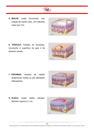 5. BOLHA:

Lesão

circunscrita,

com

coleção de líquido claro, com diâmetro
maior que 1cm.

6. PÚSTULA: Coleção de leucócitos,
circunscrita à superfície da pela e de
tamanho variado.

7. ESCAMAS:

excesso

de

células

epidérmicas mortas ou por alterações
inflamatórias.

8. PLACA:

Lesão

sólida,

elevada,

diâmetro superior a 1 cm.

19
Este material deve ser utilizado apenas como parâmetro de estudo deste Programa. Os créditos deste conteúdo são dados a seus respectivos autores

 