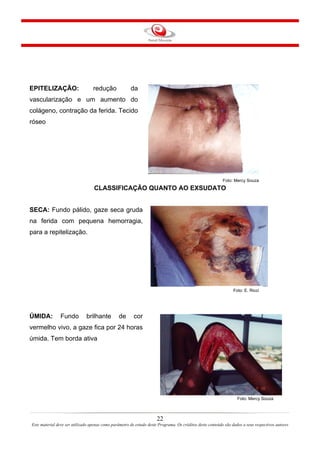 EPITELIZAÇÃO:

redução

da

vascularização e um aumento do
colágeno, contração da ferida. Tecido
róseo

Foto: Mercy Souza

CLASSIFICAÇÃO QUANTO AO EXSUDATO
SECA: Fundo pálido, gaze seca gruda
na ferida com pequena hemorragia,
para a repitelização.

Foto: E. Ricci

ÚMIDA:

Fundo

brilhante

de

cor

vermelho vivo, a gaze fica por 24 horas
úmida. Tem borda ativa

Foto: Mercy Souza

22
Este material deve ser utilizado apenas como parâmetro de estudo deste Programa. Os créditos deste conteúdo são dados a seus respectivos autores

 