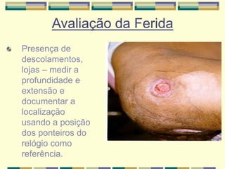 Avaliação da Ferida
Presença de
descolamentos,
lojas – medir a
profundidade e
extensão e
documentar a
localização
usando a posição
dos ponteiros do
relógio como
referência.
 