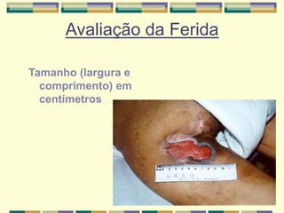 Avaliação da Ferida
Tamanho (largura e
comprimento) em
centímetros
 