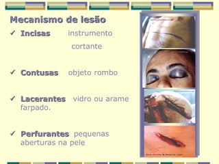 Mecanismo de lesão
 Incisas instrumento
cortante
 Contusas objeto rombo
 Lacerantes vidro ou arame
farpado.
 Perfurantes pequenas
aberturas na pele
 