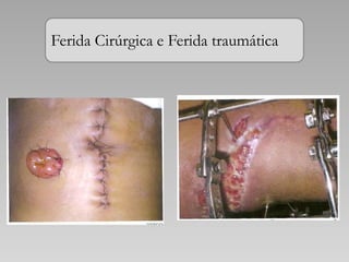Ferida Cirúrgica e Ferida traumática
 