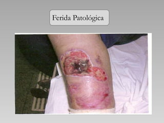 Ferida Patológica
 