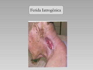 Ferida Iatrogênica
 