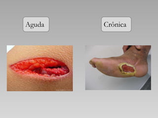 Aguda Crônica
 