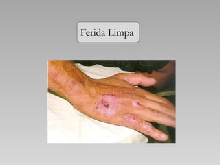 Ferida Limpa
 