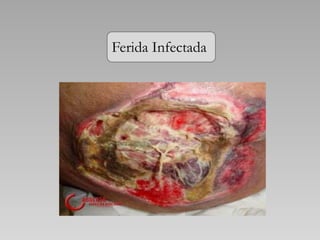 Ferida Infectada
 