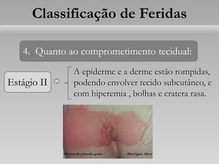 Estágio II
Classificação de Feridas
4. Quanto ao comprometimento tecidual:
A epiderme e a derme estão rompidas,
podendo envolver tecido subcutâneo, e
com hiperemia , bolhas e cratera rasa.
 