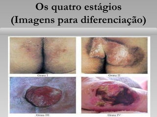 Os quatro estágios
(Imagens para diferenciação)
 